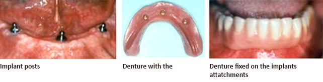 Dental Implants India