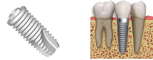Dental Implants Chembur