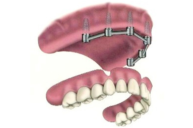 Implant Supported Complete Dentures