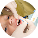 Preventive Dentistry - Fluoride Treatment