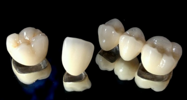 Dental Bridges and Crowns