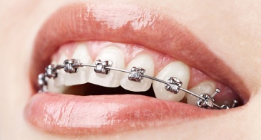 Fixed Dental Braces