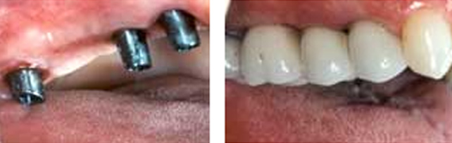 Dental Implant Bridge Mumbai