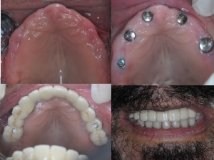 Full Mouth Implant