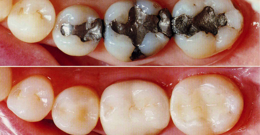 Restorative Dentistry - Tooth Coloured Restorations