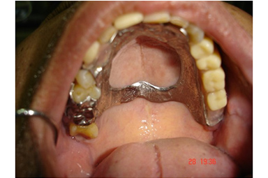 Conventional Acrylic Partial Denture