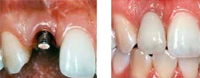 Dental Implant Post Chembur