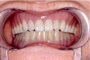 Denture treatments