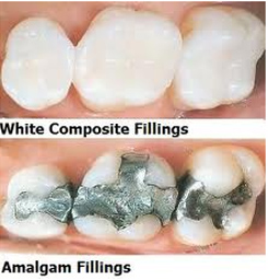White composite and amalgam fillings