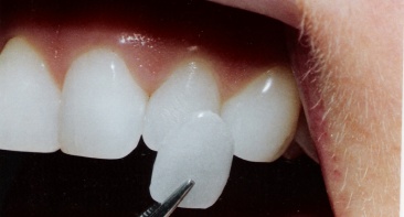 Cosmetic Dentistry - Dental Veneers